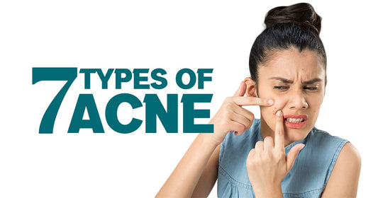 7 Types of Acne on Your Face and How to Treat Them